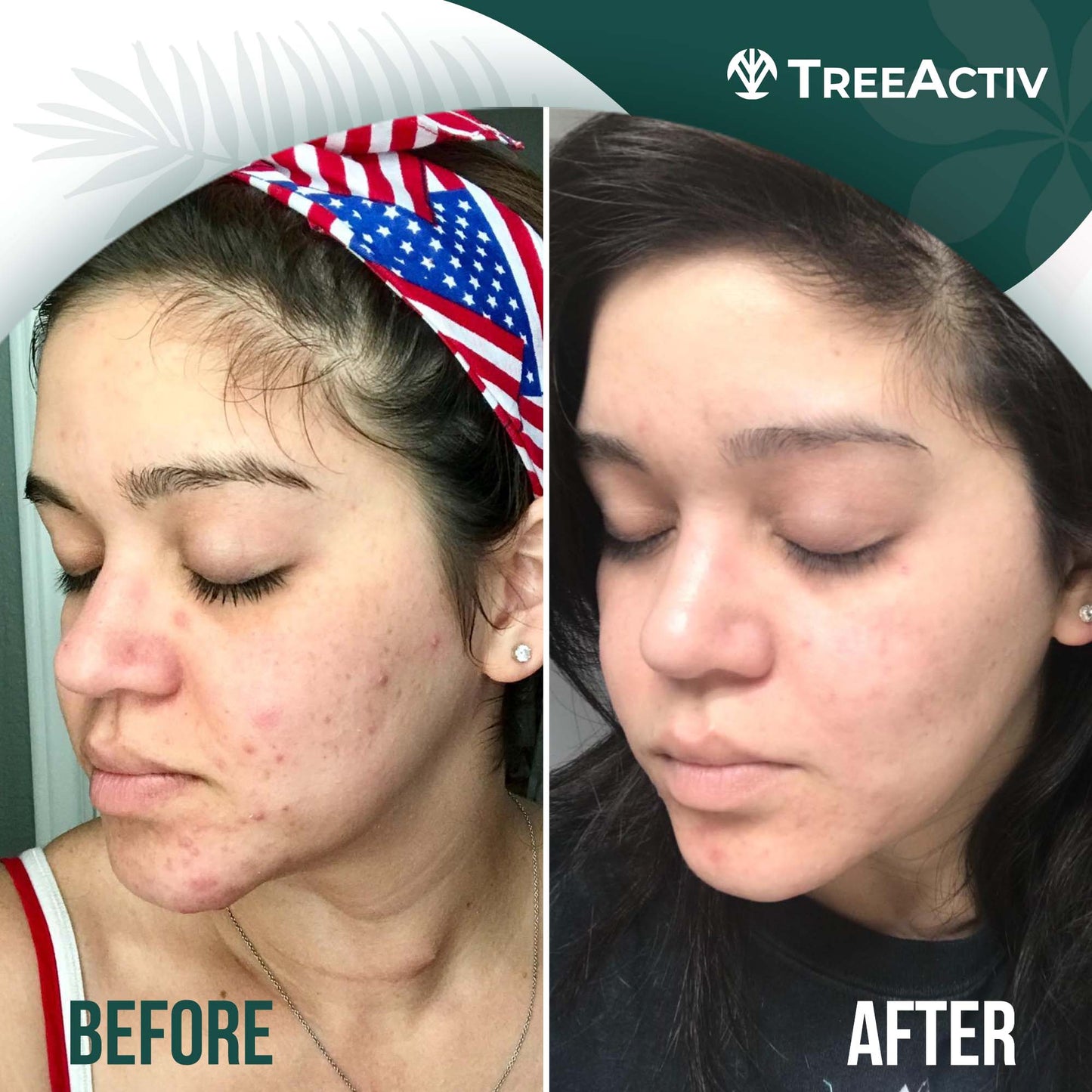 TreeActiv Acne Eliminating Face Cleanser 8 fl oz