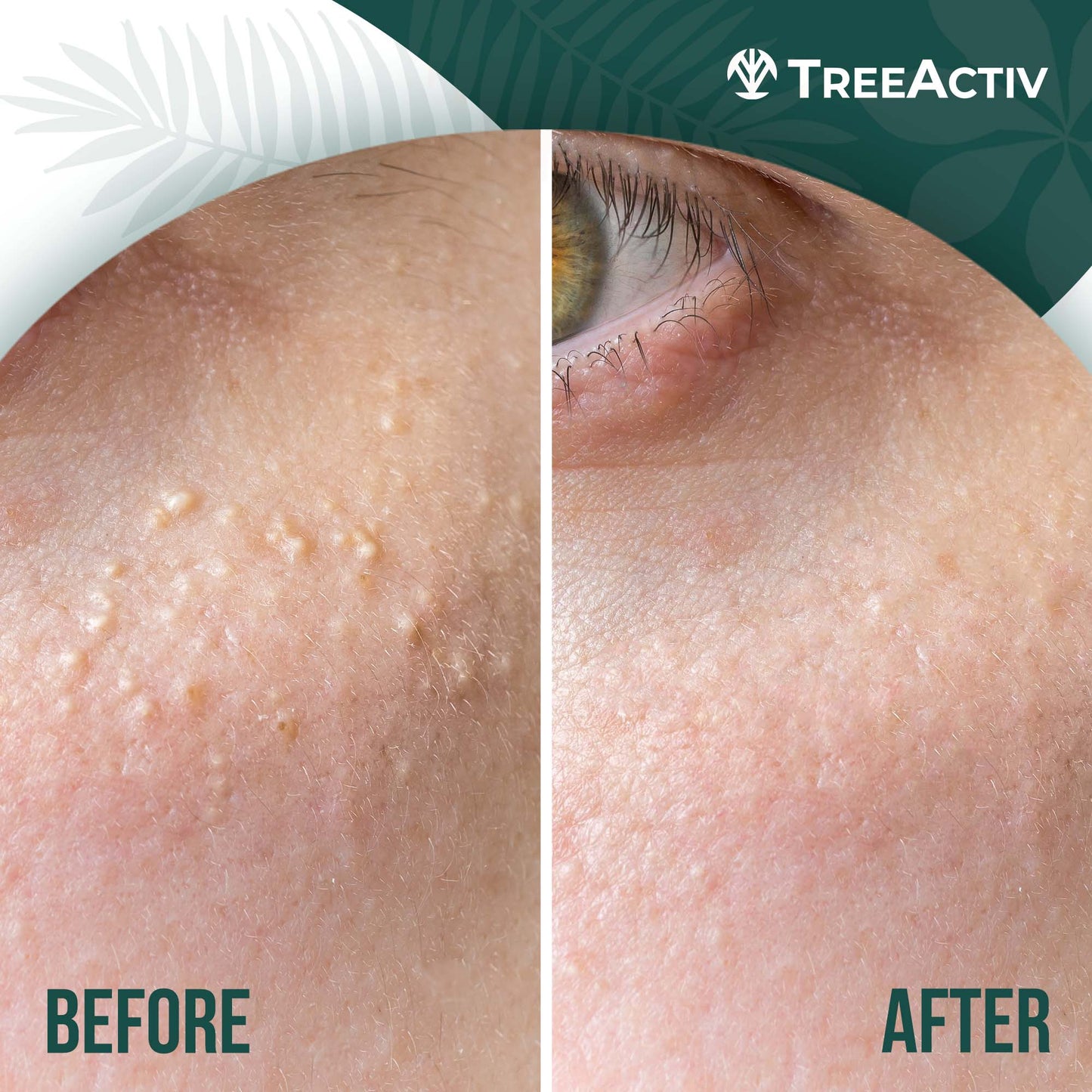 TreeActiv Milia Spot Treatment 0.5 fl oz
