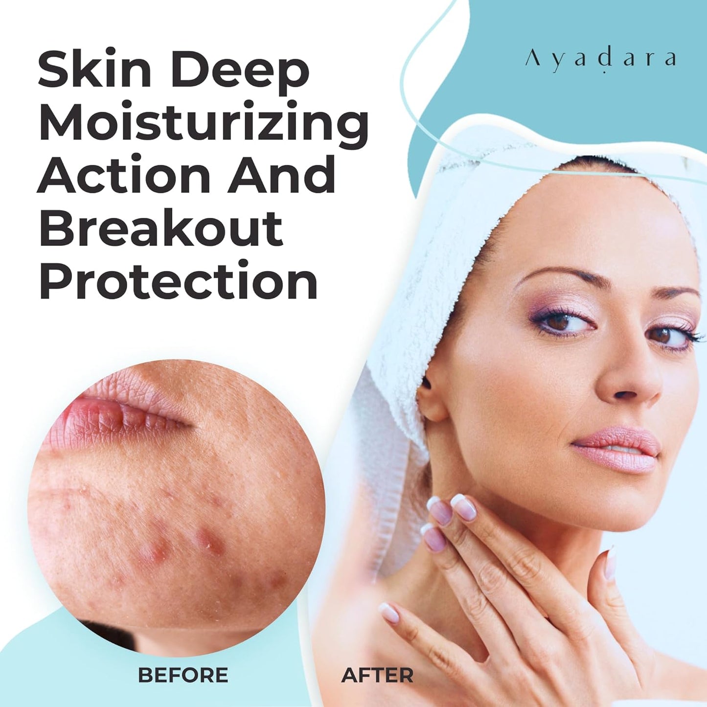 Ayadara Breakout Warrior Acne Cream Moisturizer for Face and Body 2 fl oz