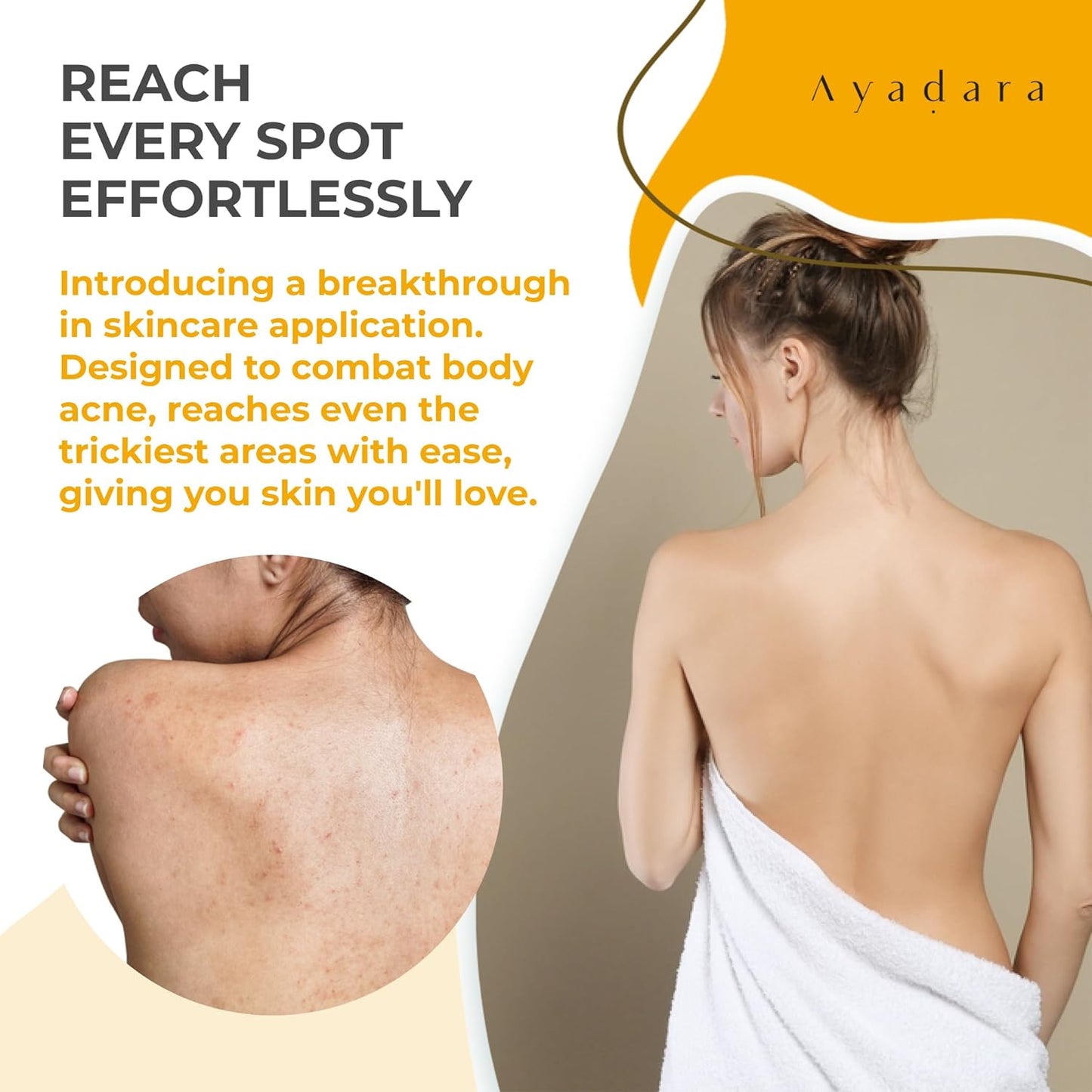 Ayadara Acne Treatment Body Spray 4 fl oz (3 Pack)