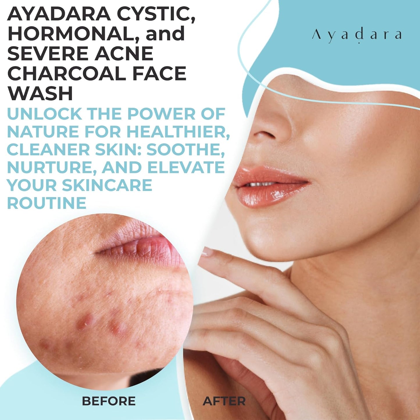 Ayadara Severe Acne Charcoal Face Wash, 3.4 fl oz