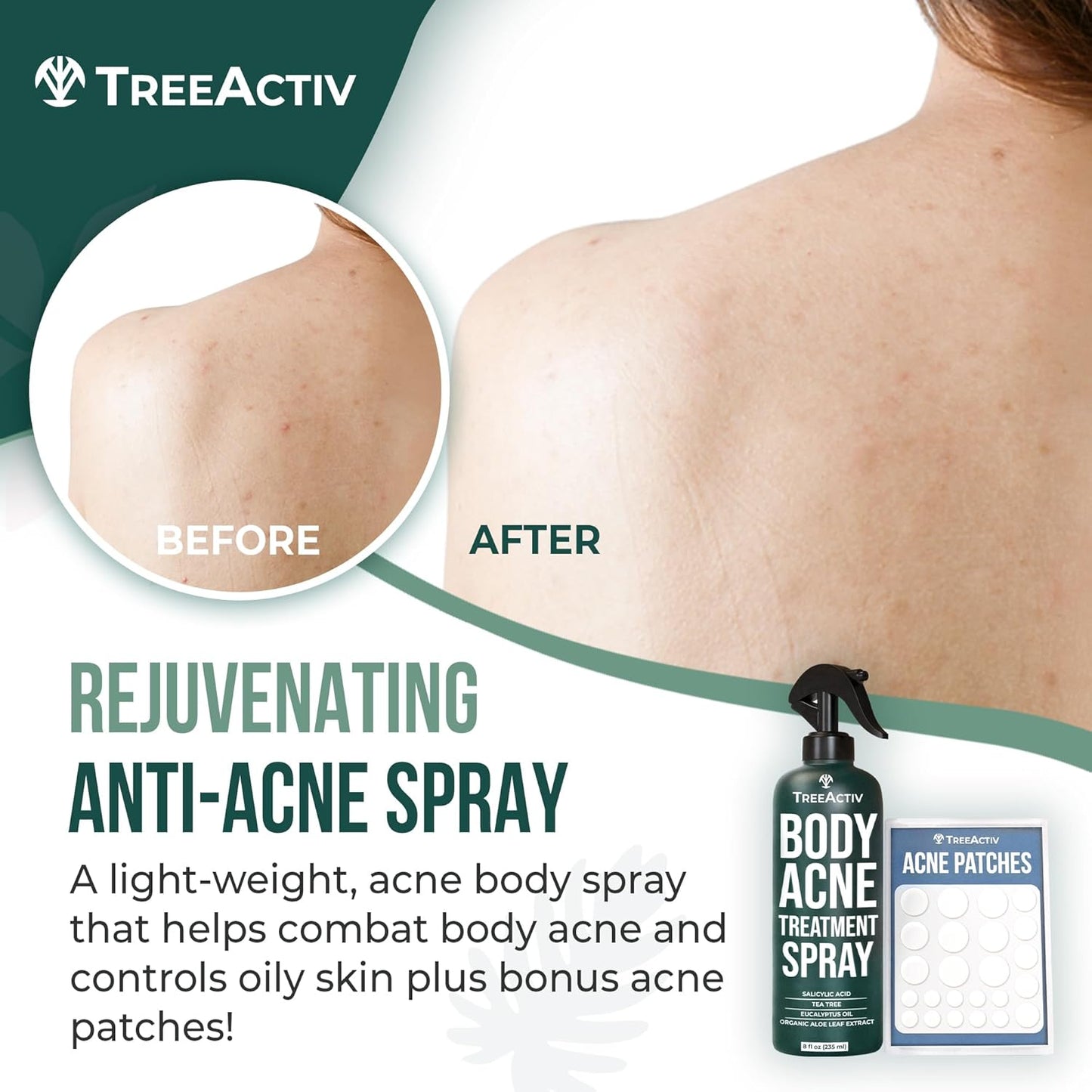 TreeActiv Acne Eliminating Body Spray 8 fl oz