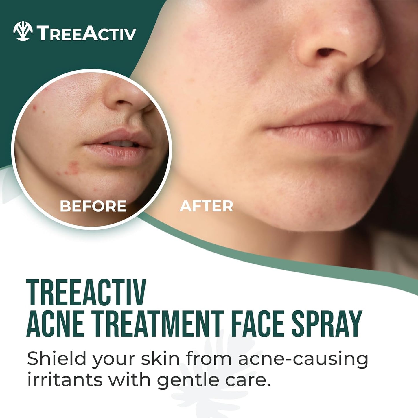 TreeActiv Acne Eliminating Face Spray 4 fl oz