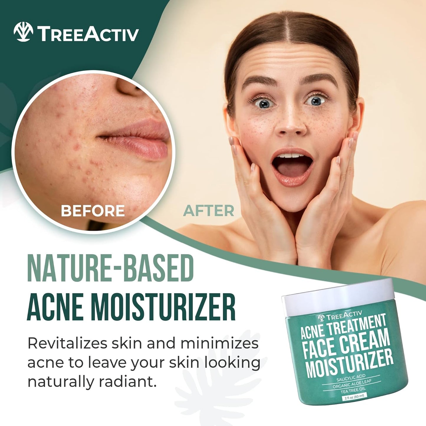 TreeActiv Acne Eliminating Face Cream 2 fl oz