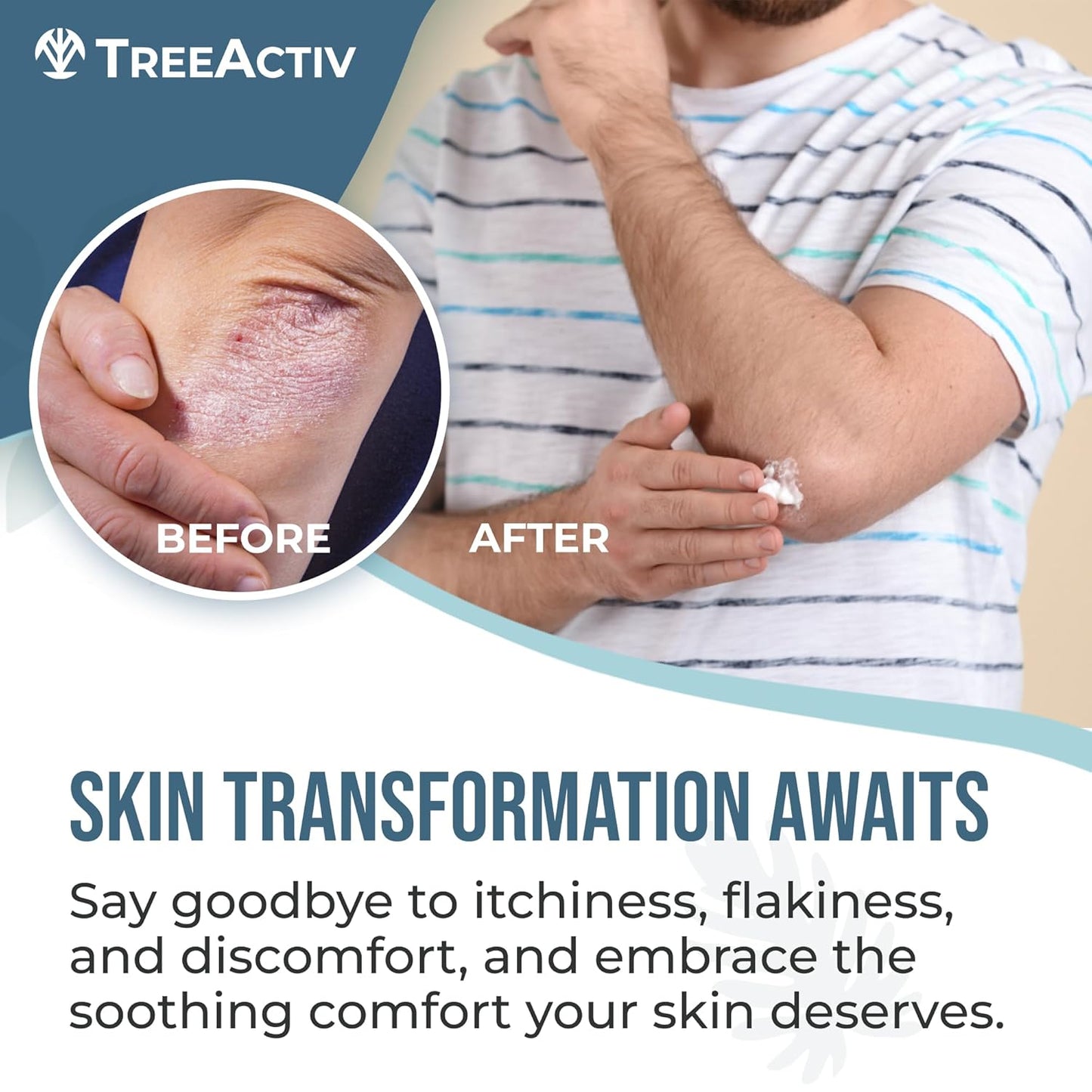 Psoriasis Treatment Cream 2 fl oz