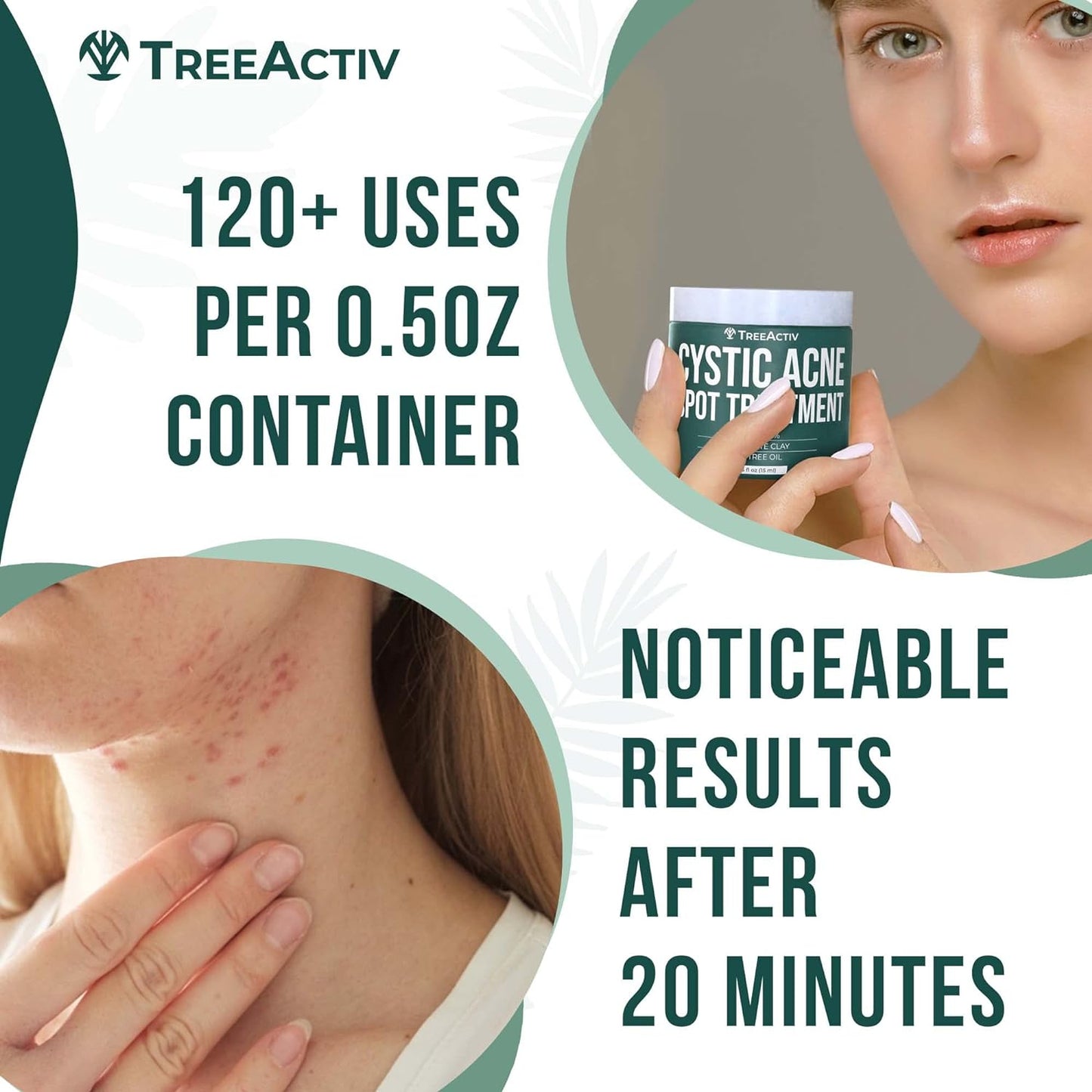 TreeActiv Cystic Acne Spot Treatment 0.5 fl oz