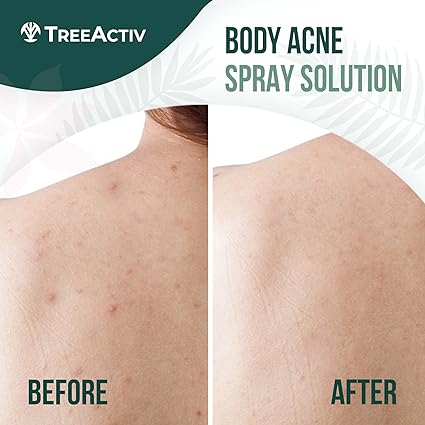 TreeActiv Acne Body Spray 4 fl oz (Pack of 2) | Severe Acne Body Spray - Gentle, Benzoyl Peroxide-Free Solution