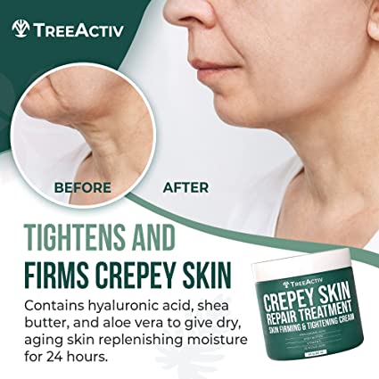 TreeActiv Crepey Skin Repair Treatment 8 fl oz | Firming Cream with Hyaluronic Acid