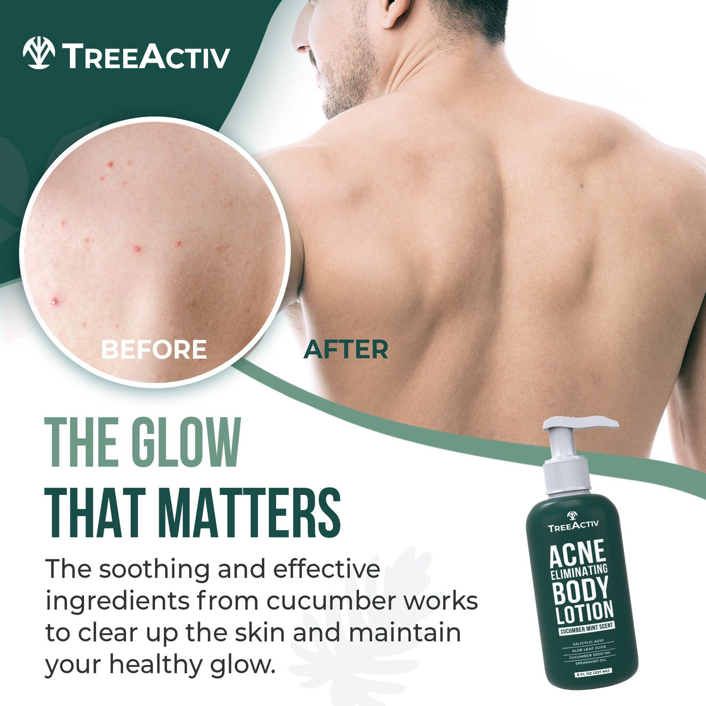 TreeActiv Acne Eliminating Body Lotion 8 fl oz | Clear Skin & Cucumber Mint Freshness