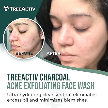 TreeActiv Charcoal Acne Face Wash 3.4 fl oz | Natural Cleanser for Clear, Smooth Skin