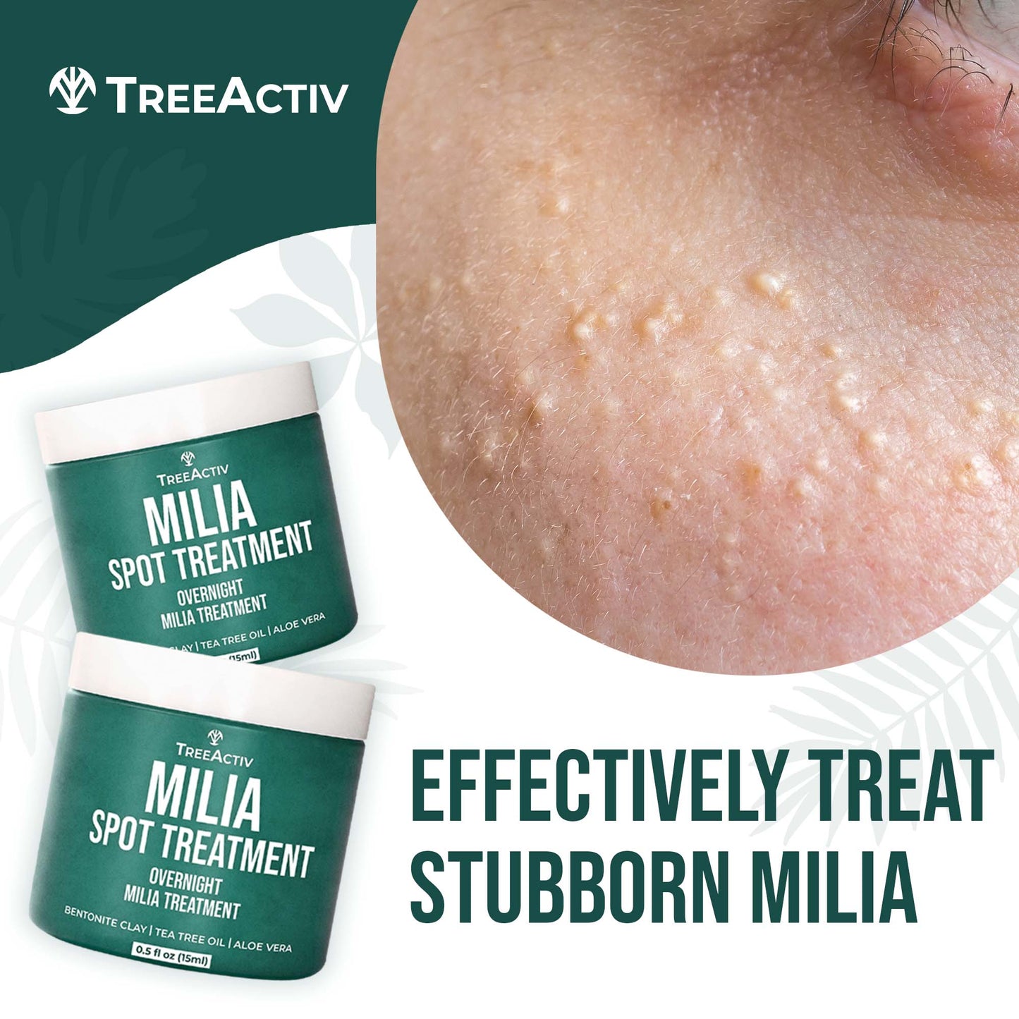 TreeActiv Milia Spot Treatment 0.5 fl oz (Pack of 2) | Natural Acne Drying Cream for Clear Skin