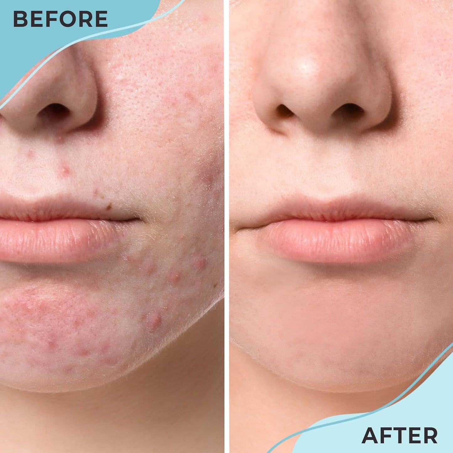Ayadara Cystic Acne Spot Treatment 0.5 fl oz