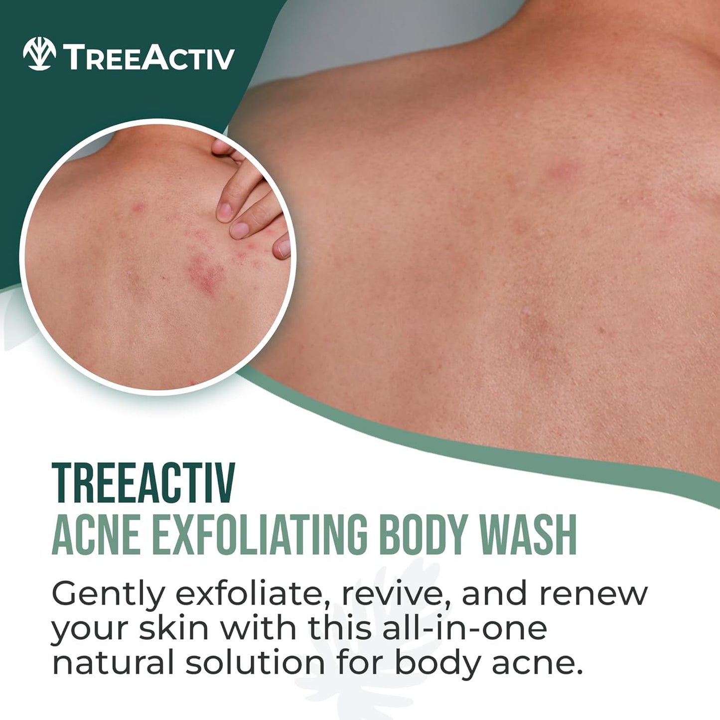 TreeActiv Anti-Acne Exfoliating Body Wash 8 fl oz