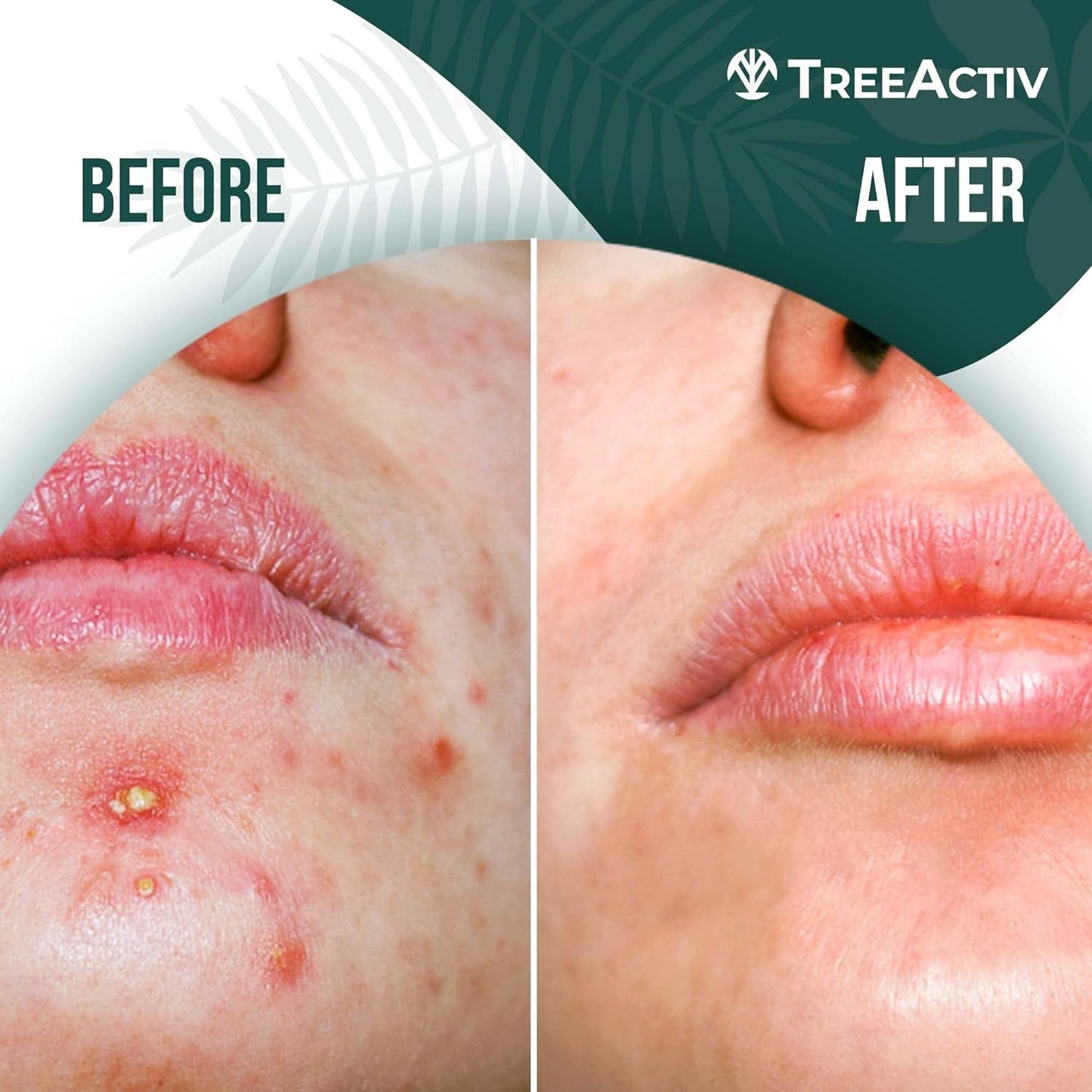 TreeActiv Cystic Acne Spot Treatment 0.5 fl oz | Fast Relief with Tea Tree Oil