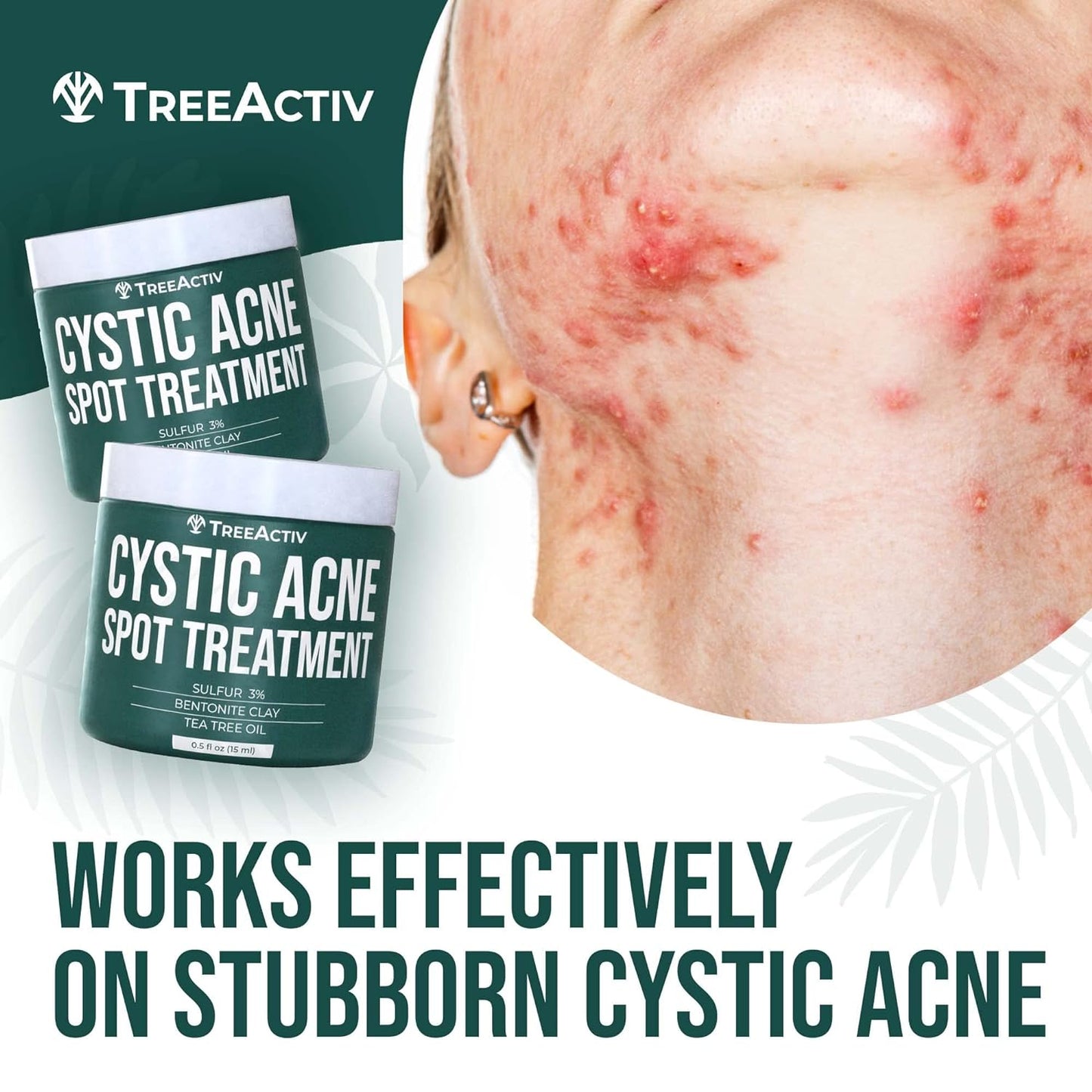 TreeActiv Cystic Acne Spot Treatment 0.5 fl oz | Fast Relief with Tea Tree Oil