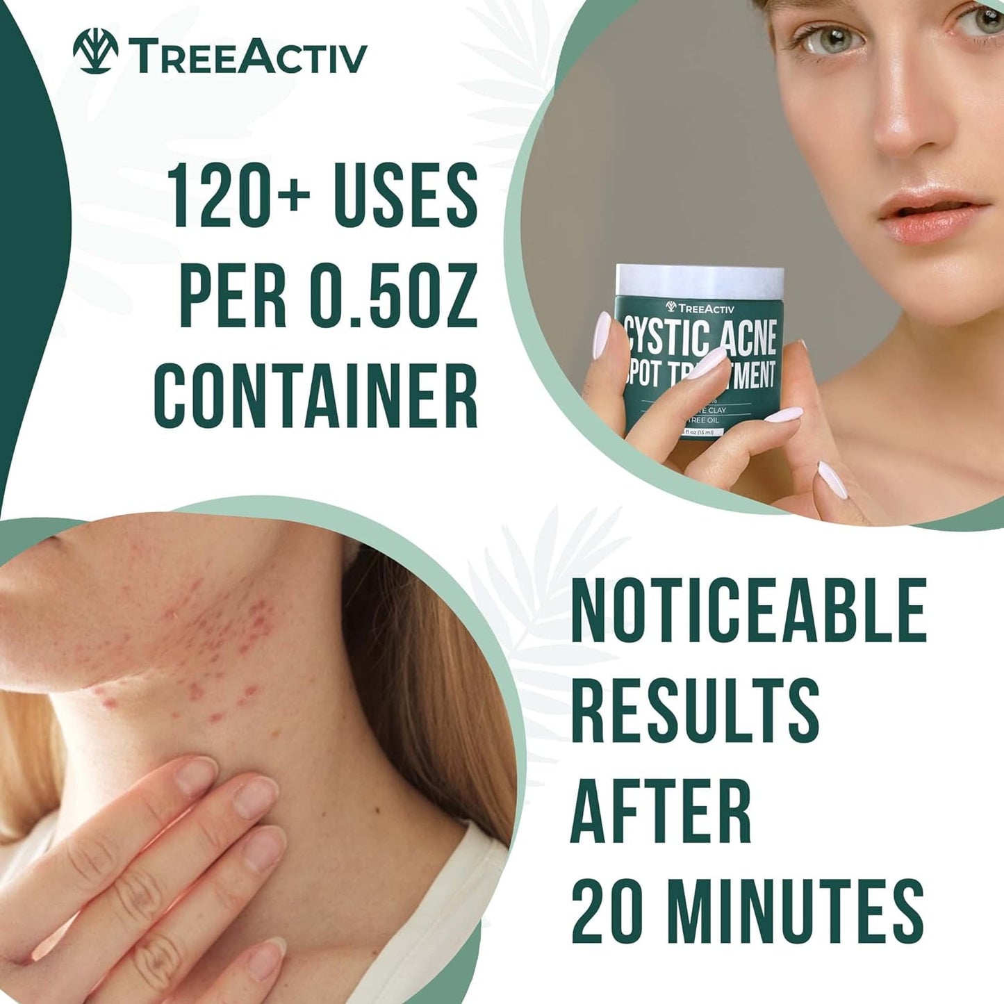 TreeActiv Cystic Acne Spot Treatment 0.5 fl oz | Fast Relief with Tea Tree Oil